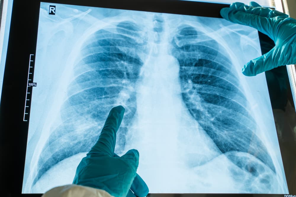 Akciğer kanseri tanı süreci ve tomografi