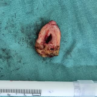 Cerrahi olarak çıkarılmış trakeal stenoz (soluk borusu darlığı) parçası